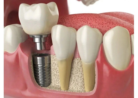Restore Your Smile with Dental Implants