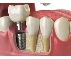 Restore Your Smile with Dental Implants
