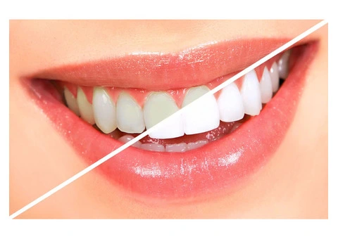 Brighten Your Smile with No Hard work Through Affordable Teeth Whitening Right now!