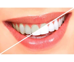Brighten Your Smile with No Hard work Through Affordable Teeth Whitening Right now!