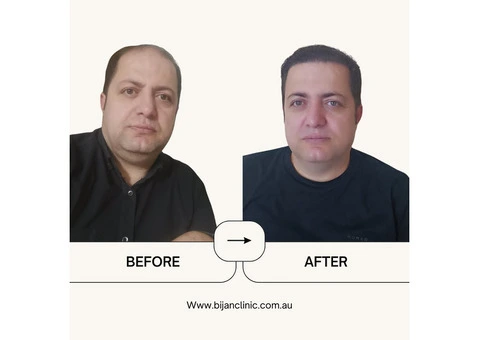 Expert Hair Restoration at Bijan Clinic: Transform Your Confidence - 1/13