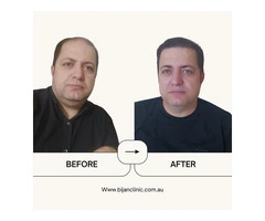 Expert Hair Restoration at Bijan Clinic: Transform Your Confidence