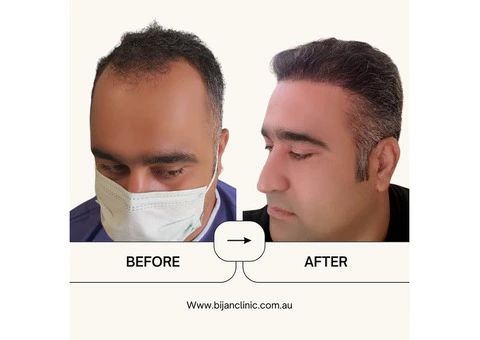 Expert Hair Restoration at Bijan Clinic: Transform Your Confidence - 2/13