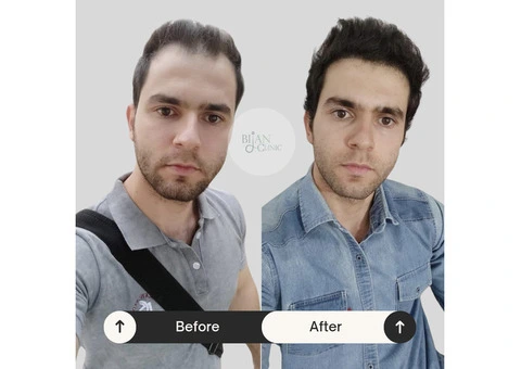 Expert Hair Restoration at Bijan Clinic: Transform Your Confidence - 3/13