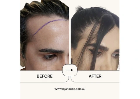 Expert Hair Restoration at Bijan Clinic: Transform Your Confidence - 4/13