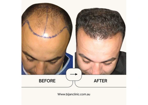 Expert Hair Restoration at Bijan Clinic: Transform Your Confidence - 5/13
