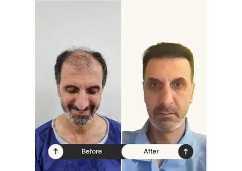 Expert Hair Restoration at Bijan Clinic: Transform Your Confidence - 6/13