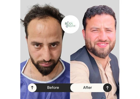 Expert Hair Restoration at Bijan Clinic: Transform Your Confidence - 7/13