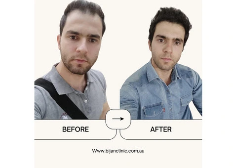 Expert Hair Restoration at Bijan Clinic: Transform Your Confidence - 8/13