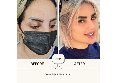 Expert Hair Restoration at Bijan Clinic: Transform Your Confidence - 9/13