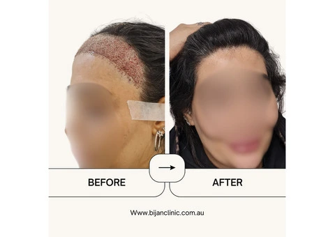 Expert Hair Restoration at Bijan Clinic: Transform Your Confidence - 10/13