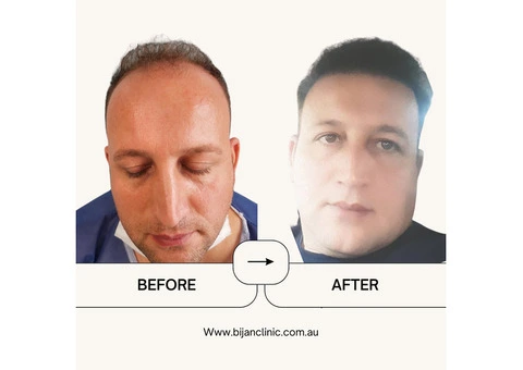 Expert Hair Restoration at Bijan Clinic: Transform Your Confidence - 11/13