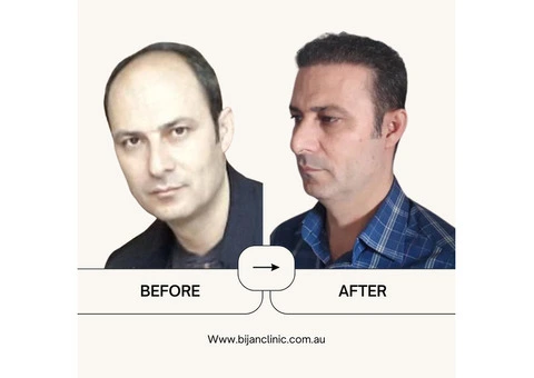 Expert Hair Restoration at Bijan Clinic: Transform Your Confidence - 12/13