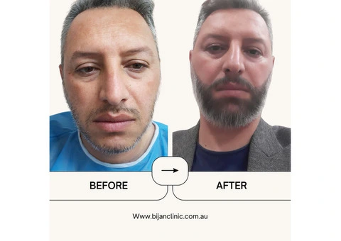 Expert Hair Restoration at Bijan Clinic: Transform Your Confidence - 13/13