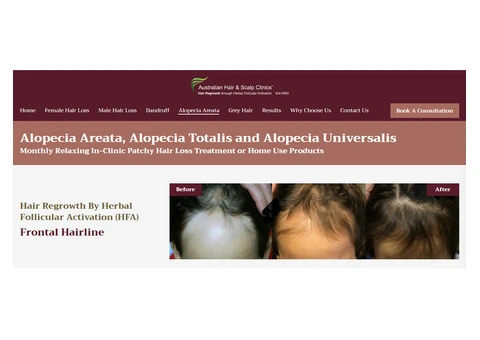 Explore Treatment Options for Alopecia Areata and Regain Confidence