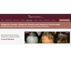 Explore Treatment Options for Alopecia Areata and Regain Confidence