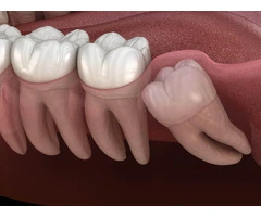 Fast and Reliable Emergency Dentist Appointment in Chatswood