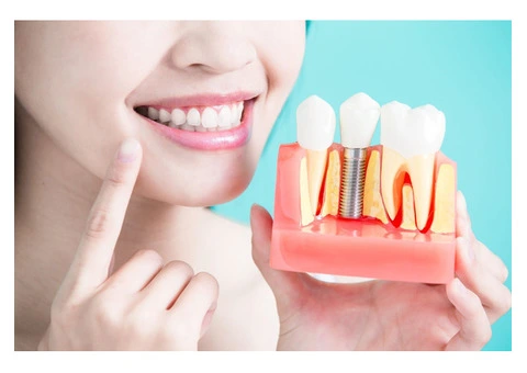 Transform Your Smile with Expert Implant Dentistry in Townsville