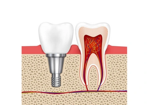Get Your Confidence Back with Top-Quality Dental Implants in NSW!