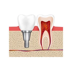 Get Your Confidence Back with Top-Quality Dental Implants in NSW!