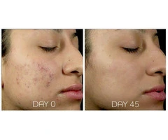 Acne Treatments for All Skin Types – OC Skin Bankstown