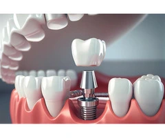 Expert Dental Implants in Richmond Restore Your Smile Today
