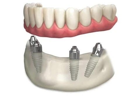 Dental Implants Melbourne Your Path to Oral Health