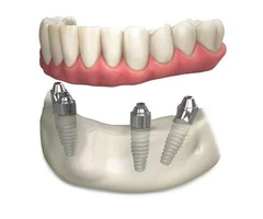 Dental Implants Melbourne Your Path to Oral Health