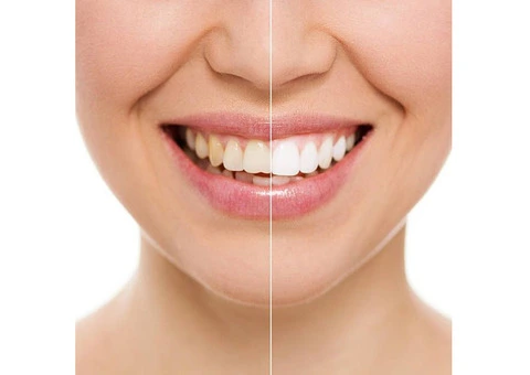 Smile Bright Teeth Whitening Melbourne CBD