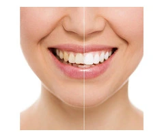 Smile Bright Teeth Whitening Melbourne CBD