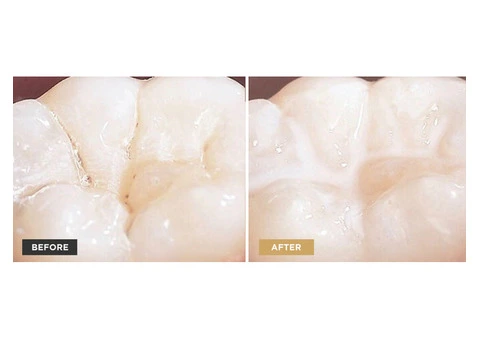 Protect Your Child's Teeth with Fissure Sealants at Grandis Dental in Banksia Grove