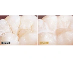 Protect Your Child's Teeth with Fissure Sealants at Grandis Dental in Banksia Grove