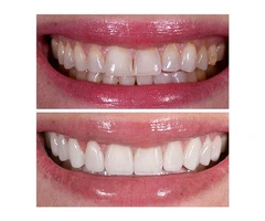 Achieve a Brighter Smile with Porcelain Veneers