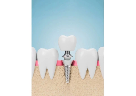 Understand Tooth Implant Cost at Smile Concepts