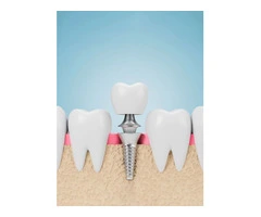 Understand Tooth Implant Cost at Smile Concepts
