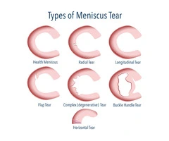 Speed Up Recovery with Proven Medial Meniscus Tear Treatments