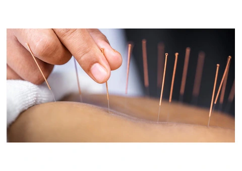 Acupuncture for stress near me - Theonacupuncture