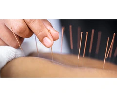 Acupuncture for stress near me - Theonacupuncture