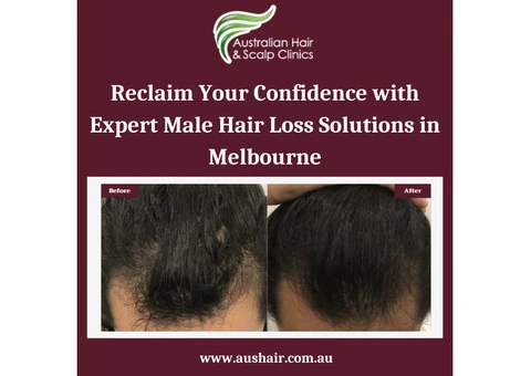 Regrow and Restore: Male Hair Loss Solutions in Melbourne