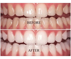 Get Ready for Events with Professional Teeth Whitening