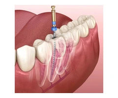 Expert Root Canal Treatment to Save Your Tooth