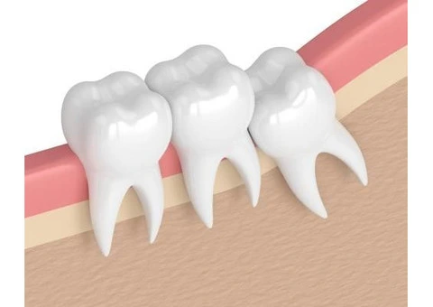 Wisdom Teeth in Melbourne: Safe, Expert Care for Impacted Teeth