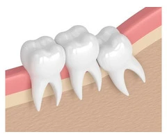 Wisdom Teeth in Melbourne: Safe, Expert Care for Impacted Teeth