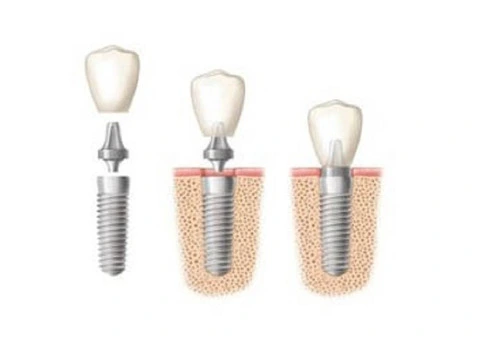 Dental Implants in Sydney – The Permanent Solution for Missing Teeth - 3/4