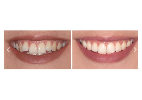 Expert Inman Aligner Treatment in Sydney for Straighter Teeth
