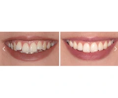 Expert Inman Aligner Treatment in Sydney for Straighter Teeth