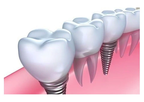 Digital Dental Implants in Sydney – Restore Your Smile with Confidence - 1/4
