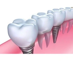 Digital Dental Implants in Sydney – Restore Your Smile with Confidence