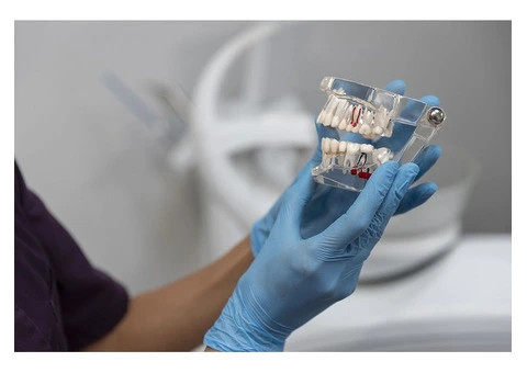 Transform Your Smile with Full Arch Implants in Warwick Perth