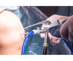 Knee Arthroscopy Surgery for Fast Recovery and Relief